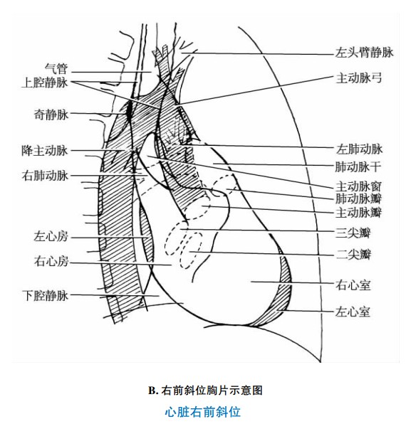 右前斜位胸片示意图