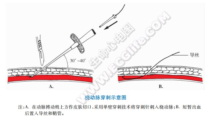 桡动脉穿刺示意图