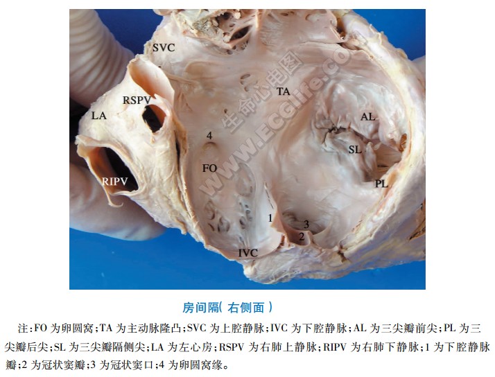 心脏房间隔右侧面解剖图