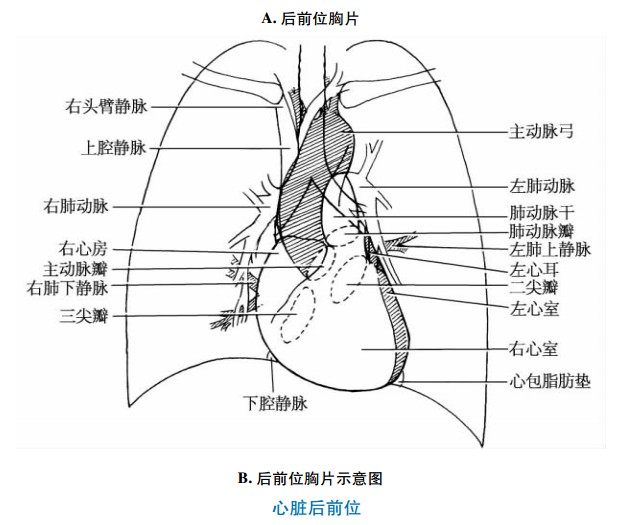 后前位胸片示意图