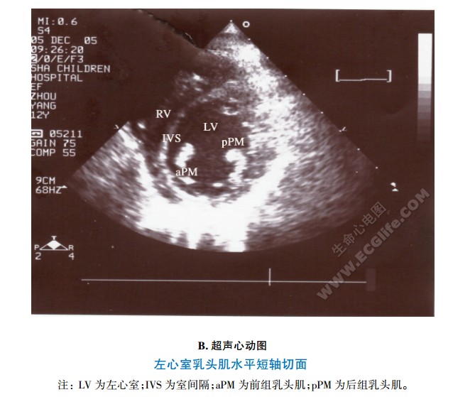 左心室乳头肌水平短轴切面、超声心动图