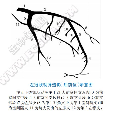 左冠状动脉造影（后前位）示意图