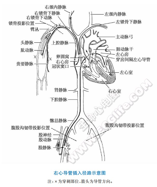 右心导管检查