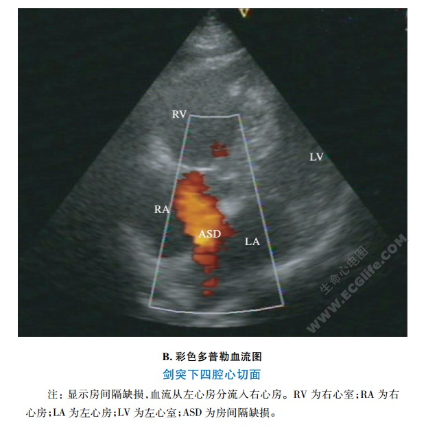 剑突下四腔心切面、彩色多普勒血流图