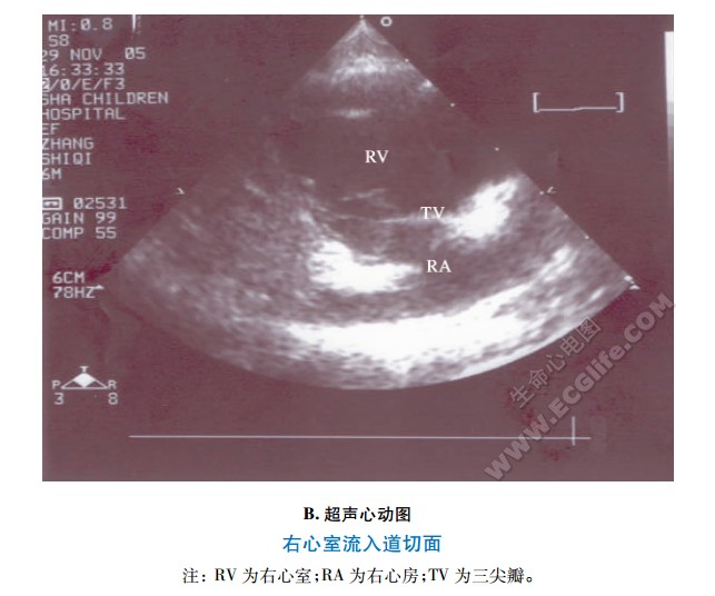 右心室流入道切面超声心动图