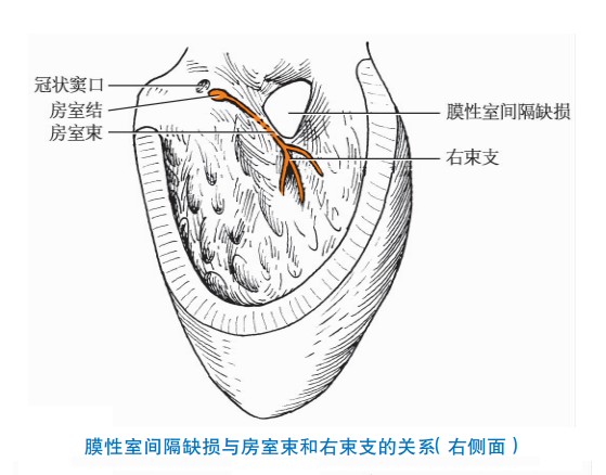 膜性室间隔缺损与房室束和右束支的关系（右侧面）