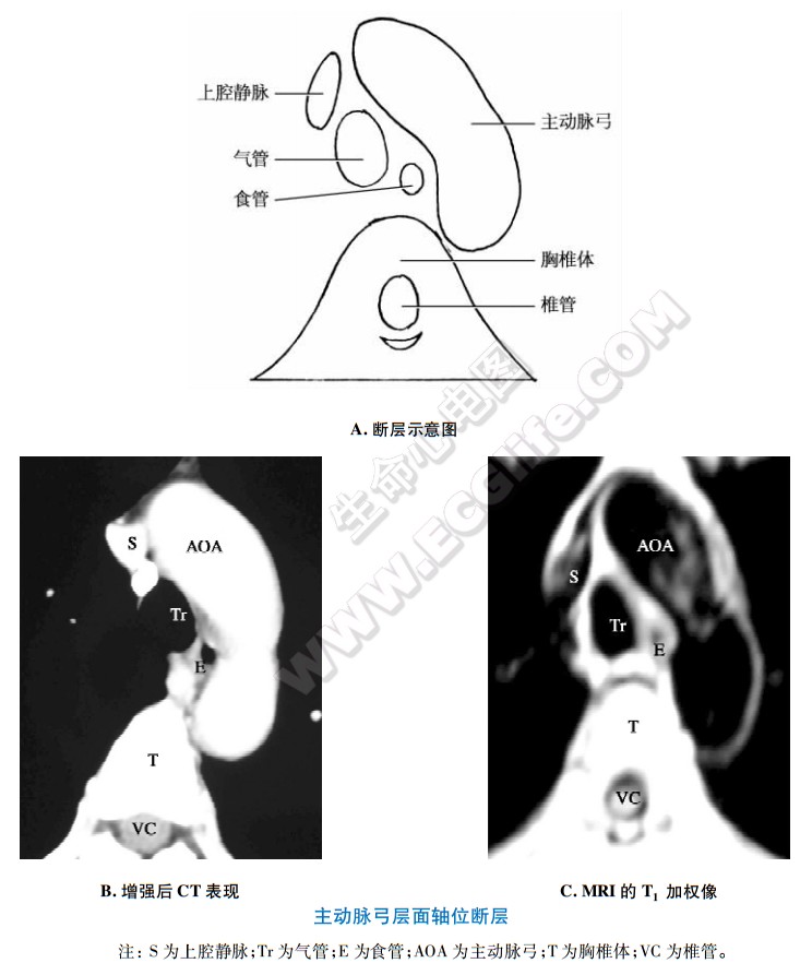 主动脉弓层面的CT和MRI断层解剖