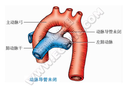 弓动脉发育畸形