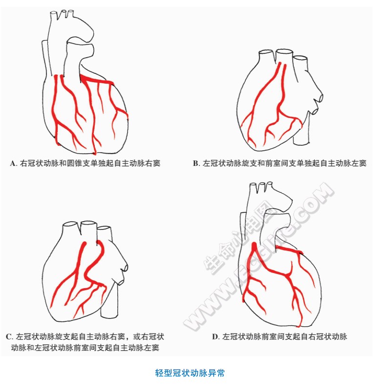 冠状动脉异常与畸形