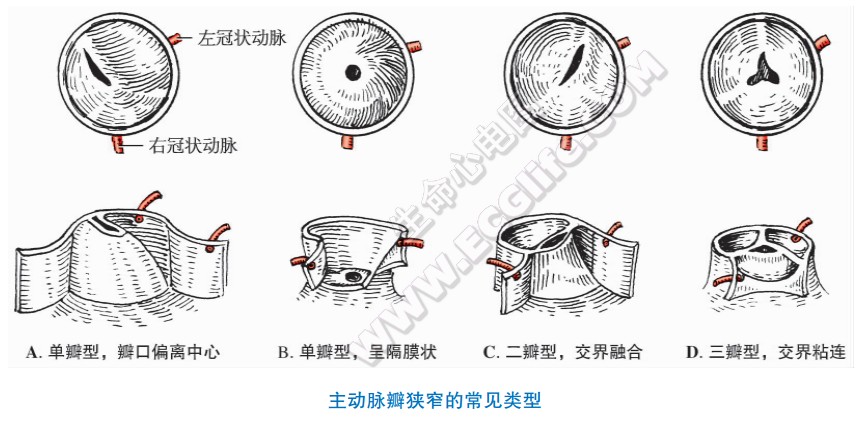 主动脉瓣狭窄的常见类型