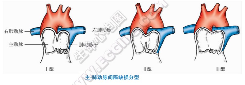 主动脉肺动脉窗图片