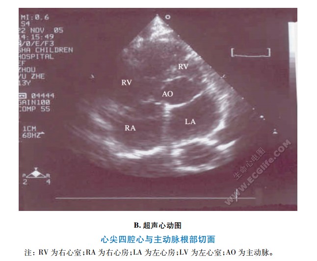 心尖四腔心与主动脉根部切面超声心动图