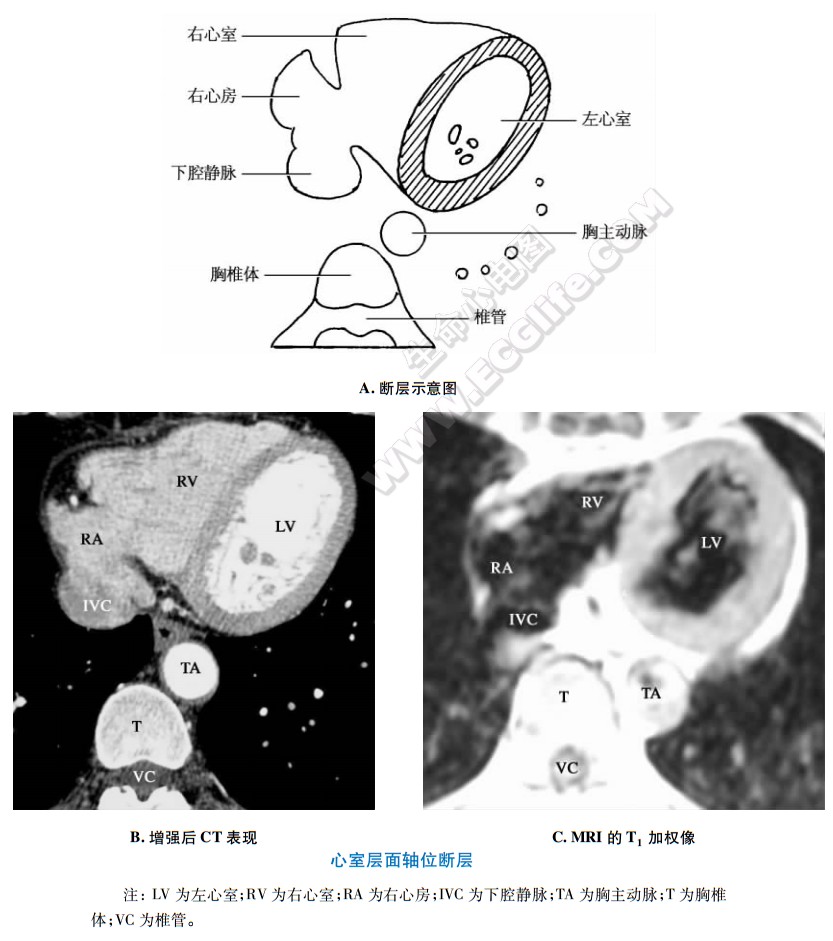 心室层面CT和MRI核磁共振断层解剖