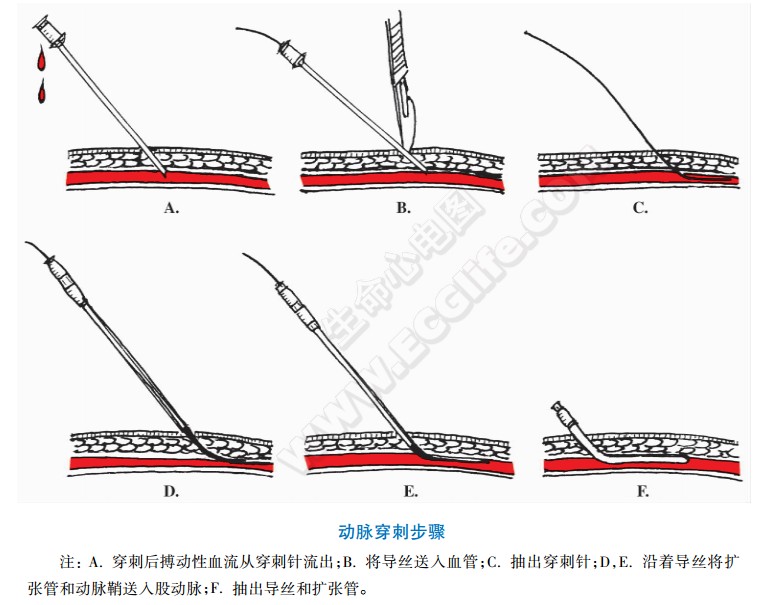 动脉穿刺步骤