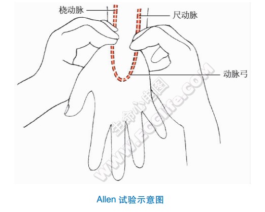 桡动脉穿刺法Allen试验