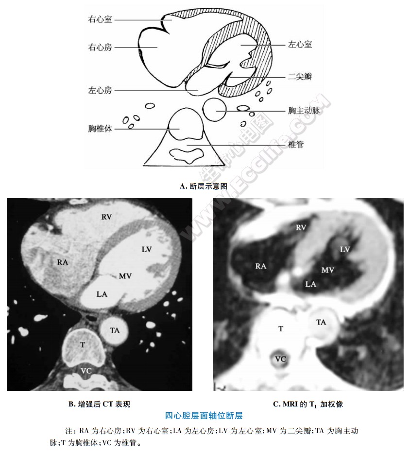 四心腔层面CT和MRI核磁共振断层解剖