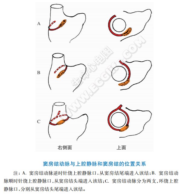 窦房结动脉与上腔静脉和窦房结的位置关系