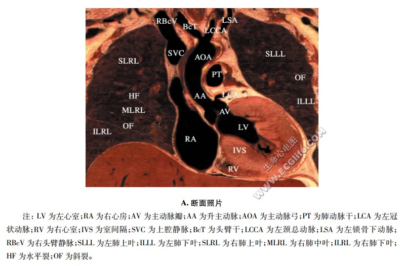 心脏冠状断面