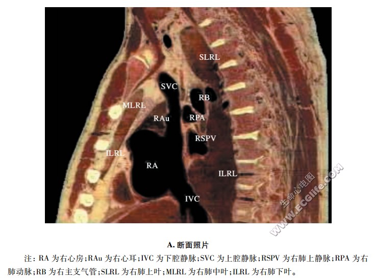 心脏右旁正中矢状断面