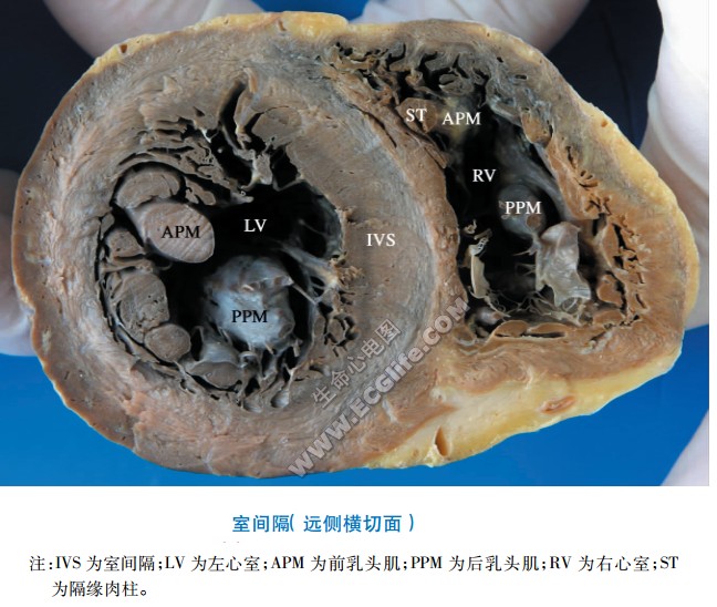 心脏室间隔远侧切割面解剖图