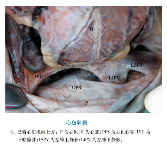 心包斜窦解剖图