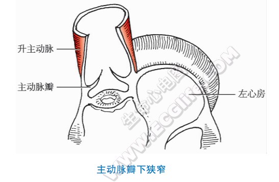 主动脉狭窄的先天性畸形