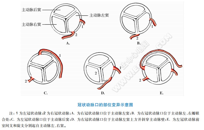 冠状动脉口的部位变异示意图