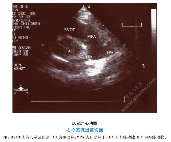 右心室流出道切面超声心动图