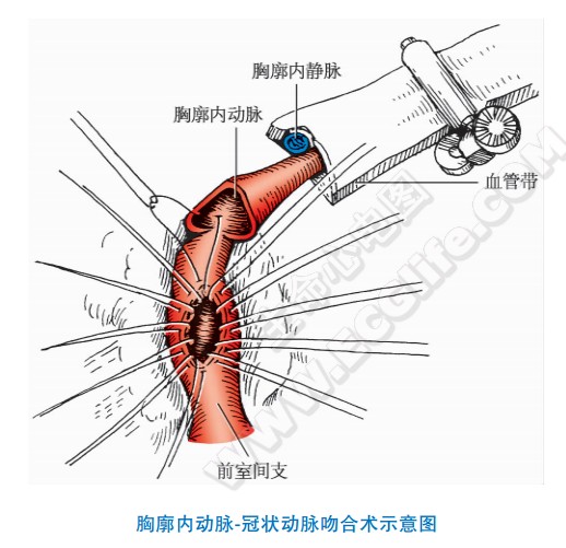 冠心病手术治疗：胸廓内动脉冠状动脉吻合术示意图