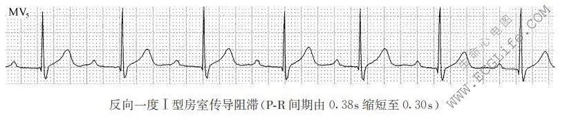 一度Ⅰ型房室传导阻滞