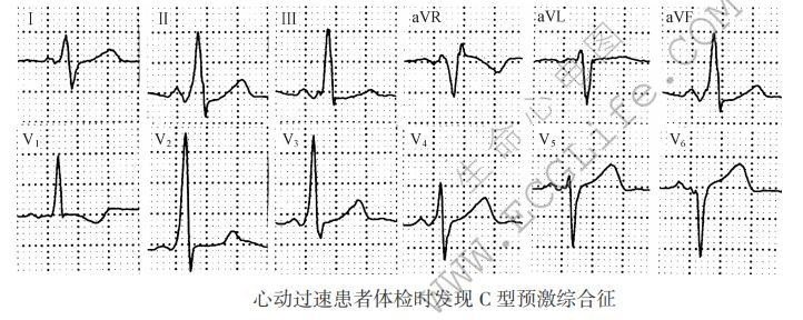 C型预激综合征（心电图）