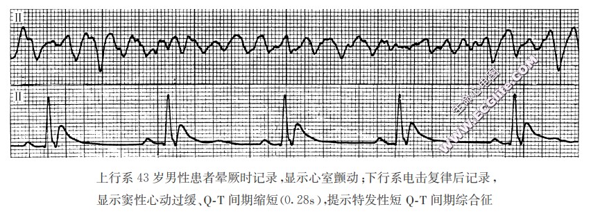 特发性QT间期缩短（心电图）