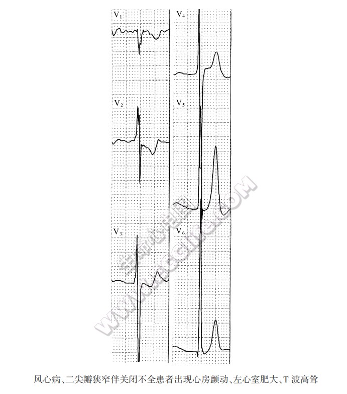 风心病、二尖瓣狭窄伴关闭不全患者出现心房颤动、左心室肥大、T波高耸（心电图）