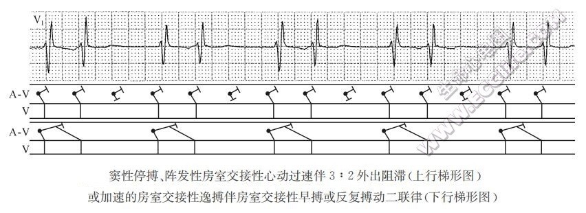 窦性停搏、阵发性房室交接性心动过速伴3:2外出阻滞（上行梯形图）或加速的房室交接性逸搏伴房室交接性早搏或反复搏动二联律fF行梯形图）（心电图）