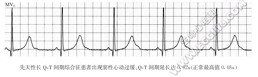 特发性QT间期延长(心电图)