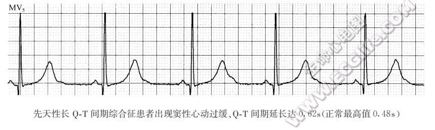 QT间期延长（特发性、继发性）