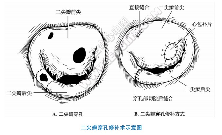 二尖擗穿孔修补术示意固