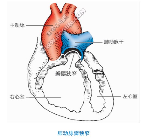 心脏先天性肺动脉瓣狭窄示意图