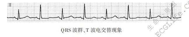 QRS波群、T波电交替现象（心电图）