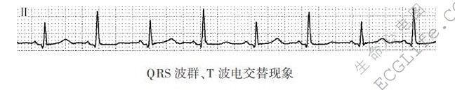 QRS波群电交替、电阶梯现象