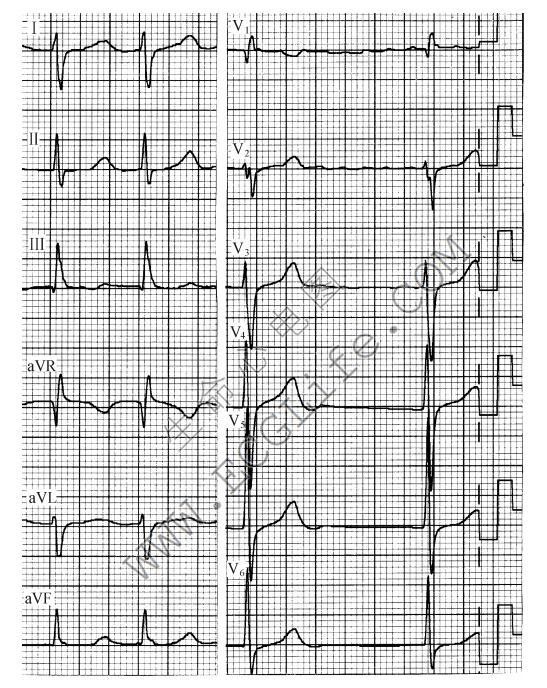 左心室肥大、电轴右偏（心电图）
