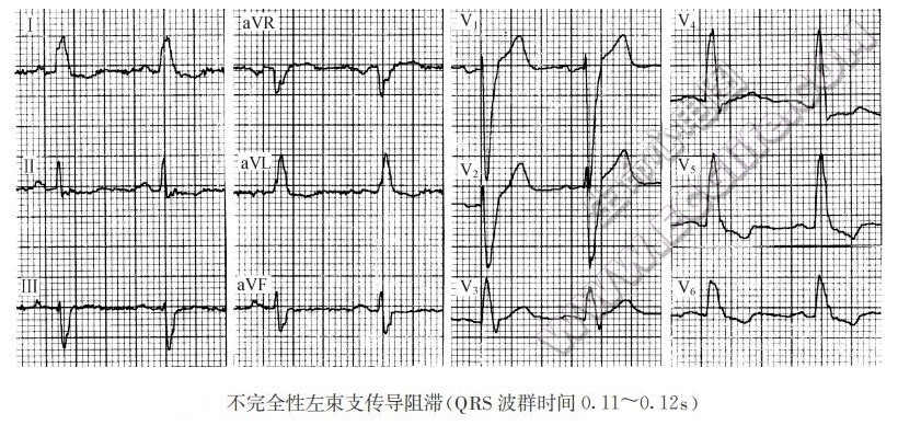 左束支传、右束支传导阻滞