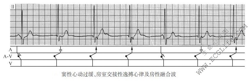 窦性心动过缓、房室交接性逸搏心律及房性融合波（心电图）