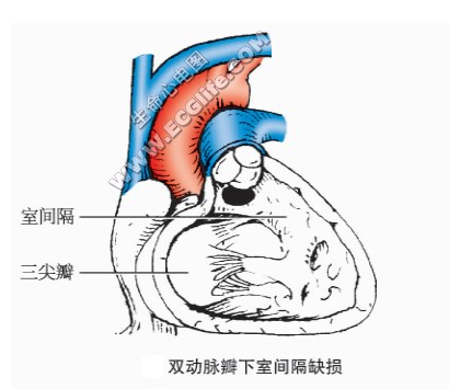 双动脉辫下室间隔缺损