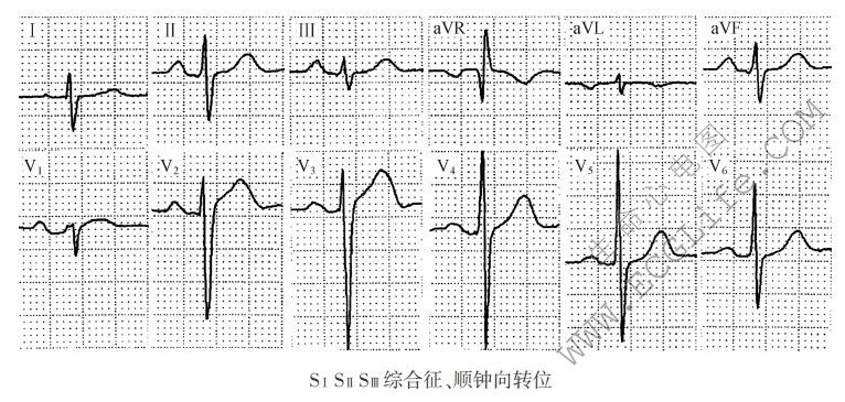 SSS综合征（心电图）