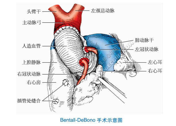 Bentall-DaBono手术示意图