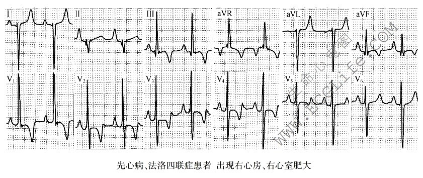 先心病、法洛四联症患者，出现右心房、右心室肥大（心电图）