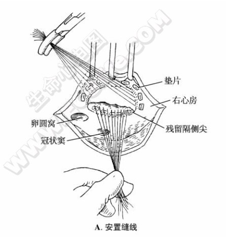 三尖瓣置换术（安置缝线）