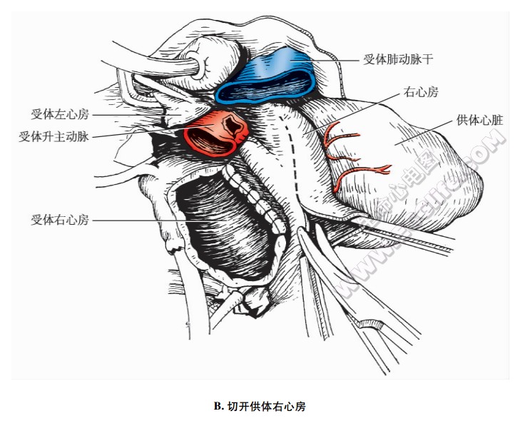 原位心脏移植：切开供体右心房