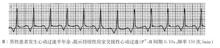 提示持续性房室交接性心动过速（心电图）